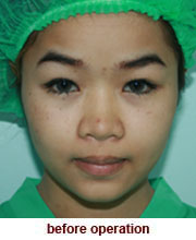 plastic_surgery_augmentation_rhinoplasty